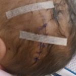 Reims : lors d'une césarienne, un bébé est blessé à la tête à coup de scalpel