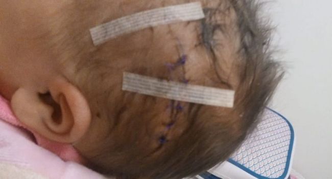 Reims : lors d'une césarienne, un bébé est blessé à la tête à coup de scalpel